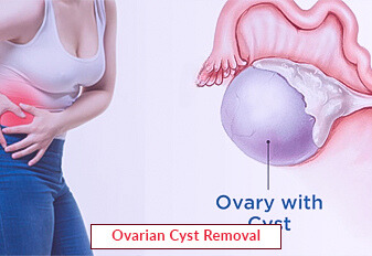 Ovarian Cyst Removal