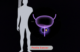 Penile Cancer