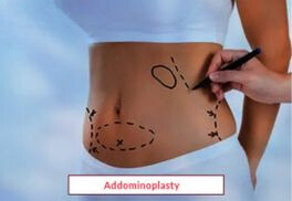 Abdominoplasty Treatment