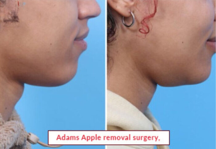 Adams Apple removal surgery