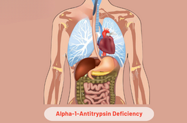 Alpha-1-Antitrypsin Deficiency