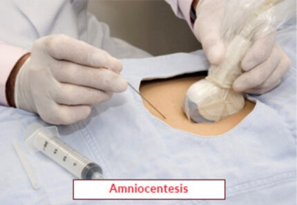 Amniocentesis