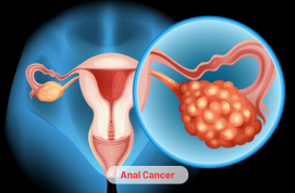 Anal Cancer Treatment