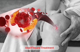 Anal Fissure Treatment