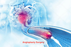 Angioplasty Surgery