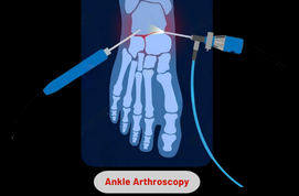 Ankle Arthroscopy