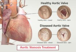 Aortic Stenosis Treatment