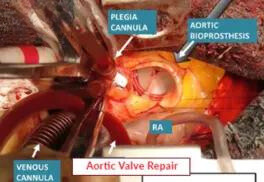 Aortic Valve Repair