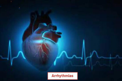 Arrhythmias