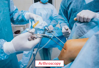 Arthroscopy Surgery