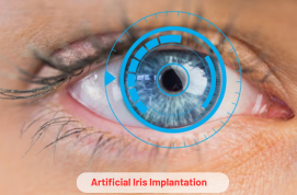 Artificial Iris Implantation