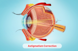 Astigmatism Correction