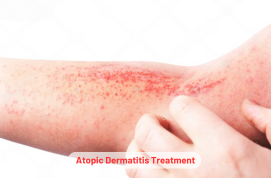 Atopic Dermatitis Treatment