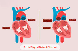 Atrial Septal Defect Closure