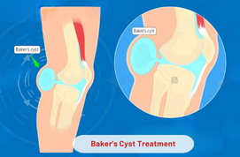 Baker’s Cyst Treatment