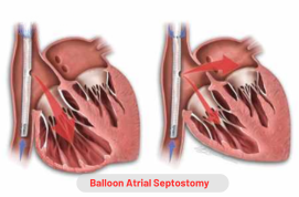 Balloon Atrial Septostomy