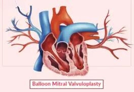 Balloon Mitral Valvuloplasty