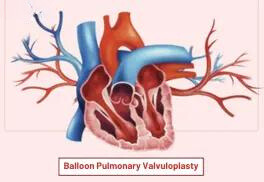 Balloon Pulmonary Valvuloplasty