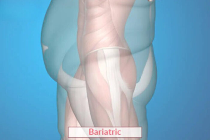 Bariatric Surgery