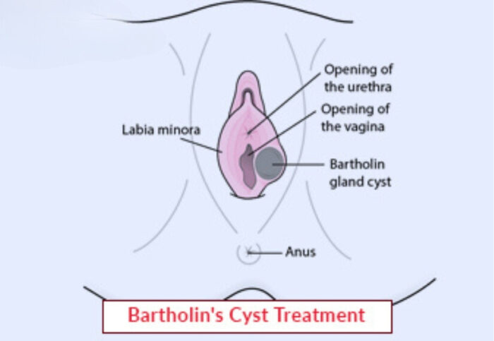 Bartholin’s Cyst Treatment