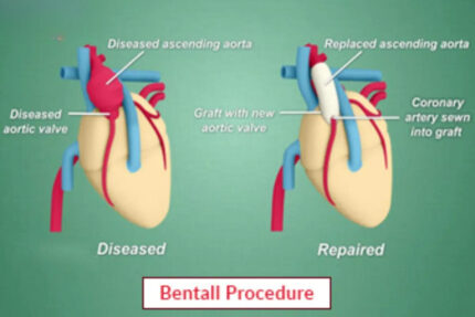 Bentall Procedure