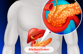 Bile Duct Cancer - Cholangiocarcinoma