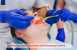 Biliopancreatic Diversion With Duodenal Switch