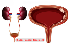 Bladder Cancer Treatment