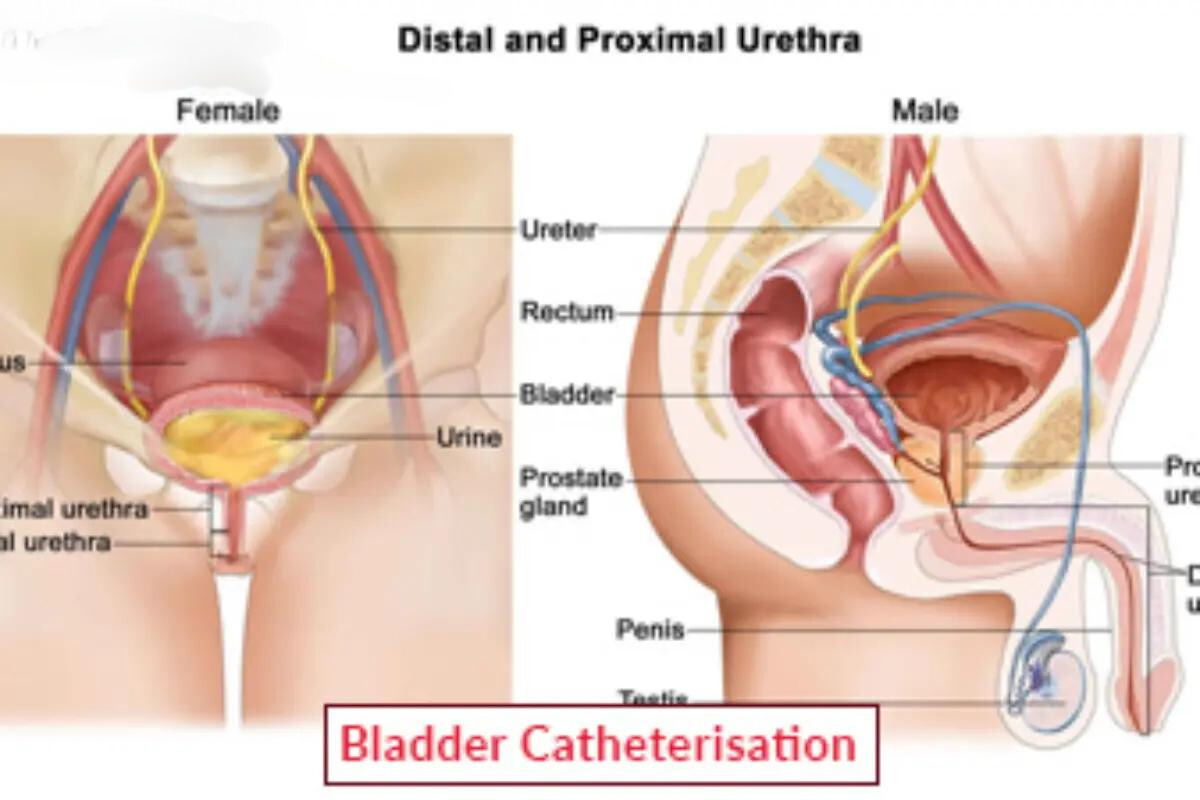 Bladder Catheterization