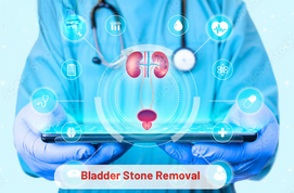 Bladder Stone Removal