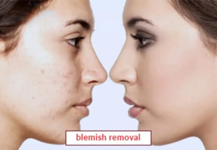 Blemish Removal