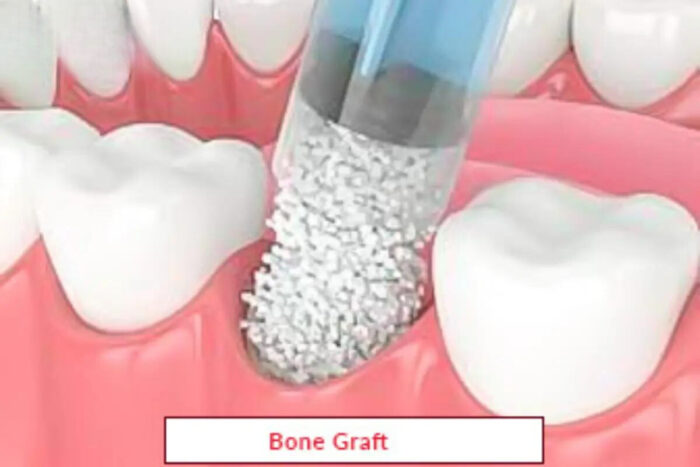 Bone Graft Treatment