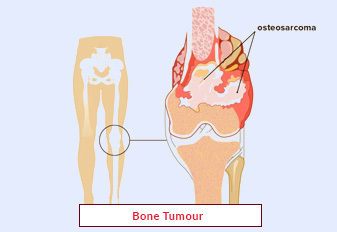 Bone Tumor