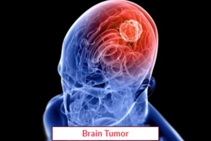 Brain Tumor