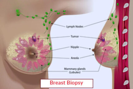 Breast Biopsy