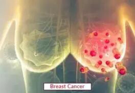 Breast Cancer Treatment