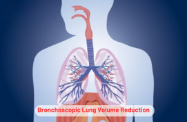 Bronchoscopic Lung Volume Reduction