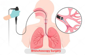 Bronchoscopy Surgery