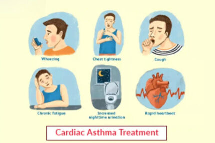 Cardiac Asthma Treatment