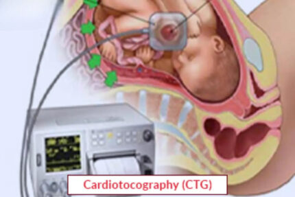 Cardiotocography (CTG)