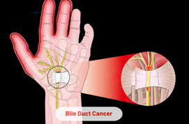 Carpal Tunnel Release Surgery