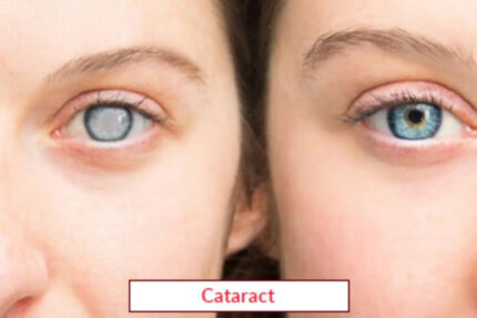 Cataract Surgery