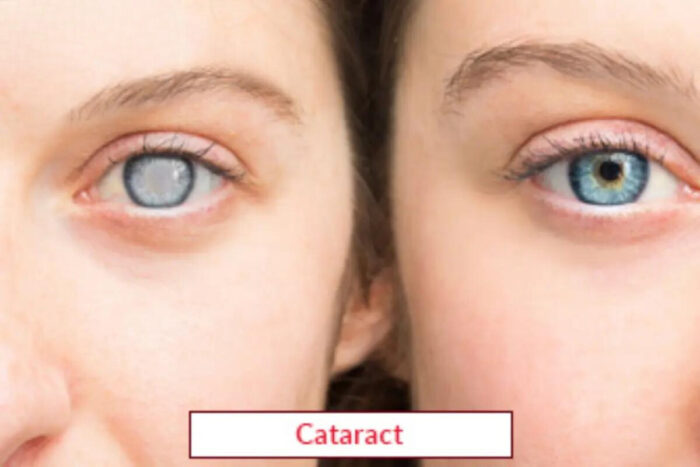 Cataract Surgery