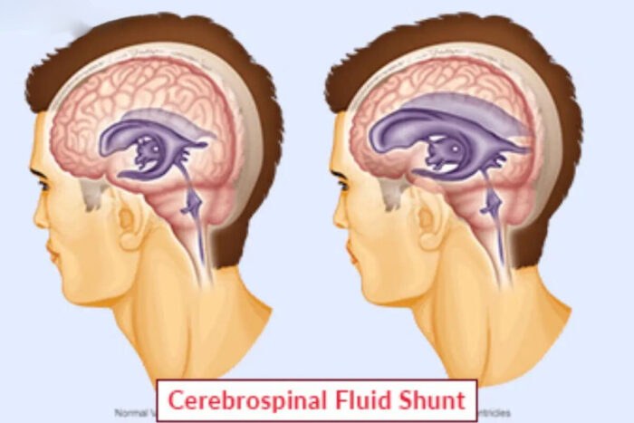 Cerebrospinal Fluid Shunt