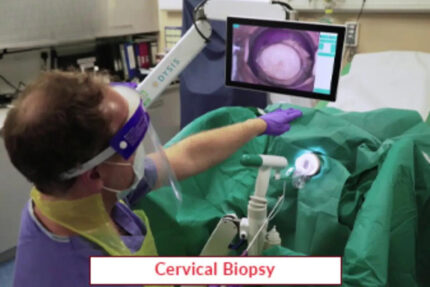 Cervical Biopsy