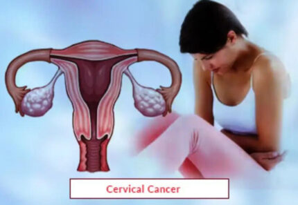 Cervical Cancer Treatment