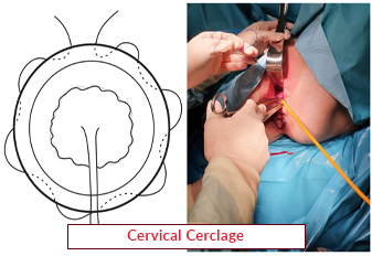 Cervical Cerclage