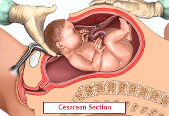 Cesarean Section