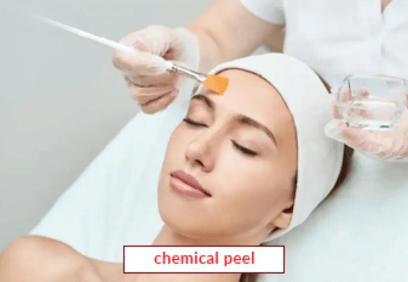 Chemical Peel