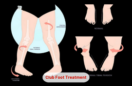 Club Foot Treatment